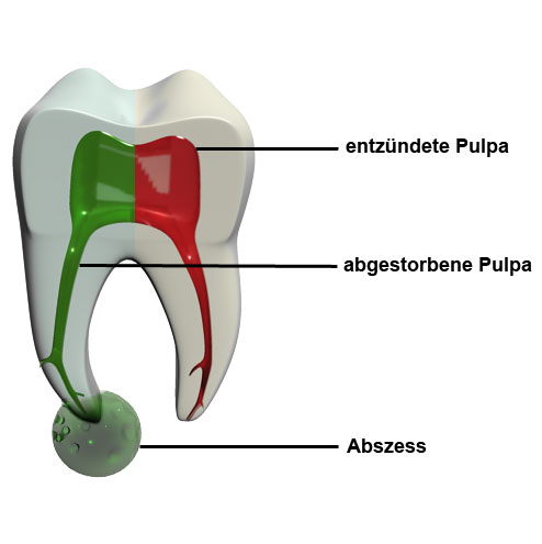Molar_pulpitisformen
